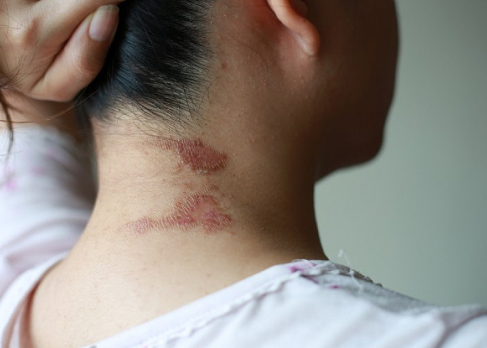 Dermatitis Venenata! Penyakit Kulit Akibat Sentuhan Tomcat