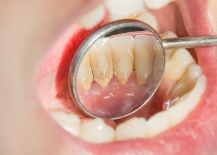 Sering Disepelekan, Berikut 6 Cara Menghilangkan Plak pada Gigi 
