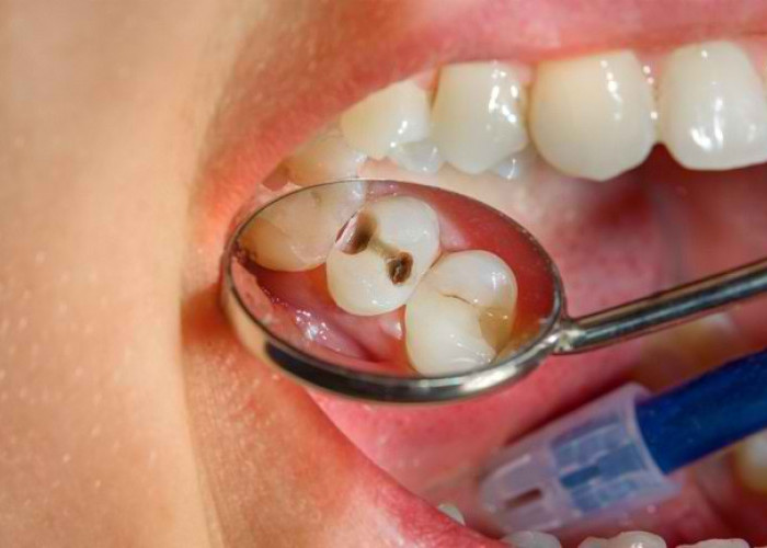 Jangan Anggap Sepele! Kenali Risiko dan Bahaya Gigi Berlubang