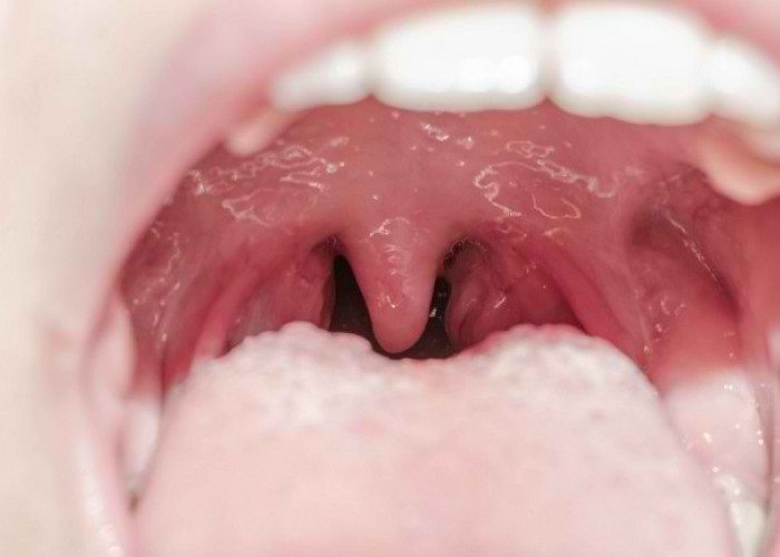 Tonsil dan Jenis Penyakit yang Dapat Menyerangnya