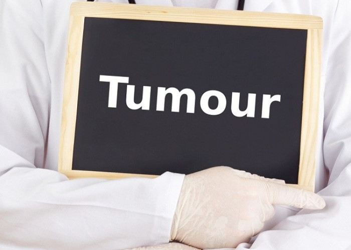 Ini Dia Beberapa Penanganan dan Pengobatan Tumor yang Umum Digunakan