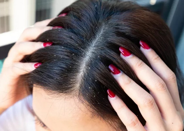 Tips Merawat Rambut! Kenali Jenis Ketombe yang Harus Kamu Tahu