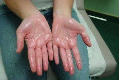 Sering Berkeringat Berlebihan? Ini Fakta Hyperhidrosis yang Perlu Diketahui